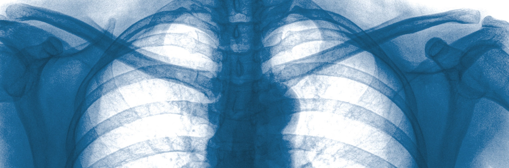 Journée Luxembourgeoise contre la BPCO (Broncho pneumopathie chronique obstructive)